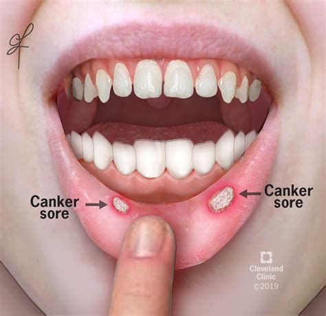 How to Get Rid of Canker Sores (Aphthous Ulcer) .